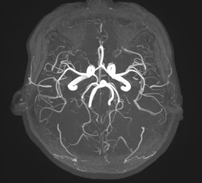 头颅MRA解剖图片