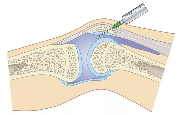 目前,在關節腔內注射玻璃酸鈉是治療半月板損傷的一種主要方法.