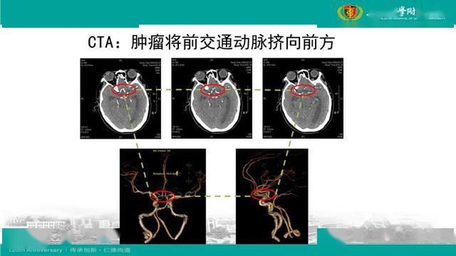 經縱裂前交通動脈終板入路三腦室顱咽管瘤切除術