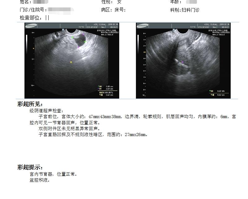 宫内节育环超声图片图片