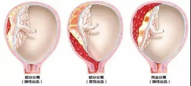 胎盘早剥凶险万分孕期预防及时治疗是关键
