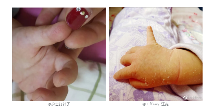 宝宝小手皲裂有4大成因,如何预防护理,你知道吗?_皮肤