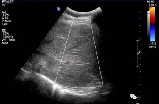 獭尾肝超声图片