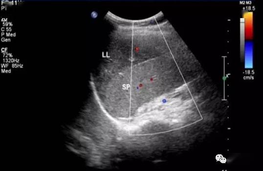 肝脏尾状叶超声图片图片