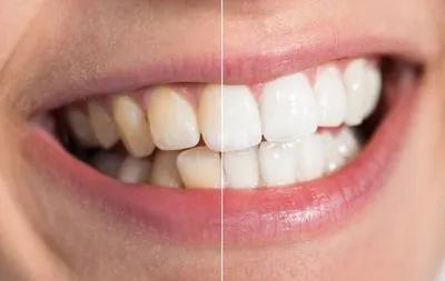 铂尔汀在做美牙之前这9个问题99的人都问过牙齿贴面须知事项