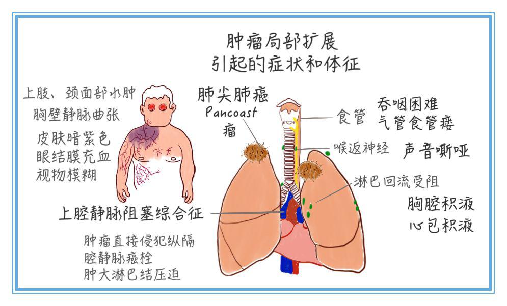 医学漫画癌中之王肺癌过目不忘病因机制症状体征诊断分期治疗