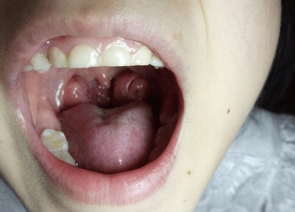 原创5岁女儿口臭被同学嫌弃爸妈带去就医嘴里取出的东西让人想吐