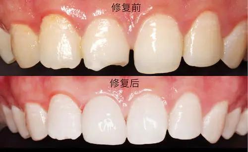 铂尔汀在做美牙之前这9个问题99的人都问过牙齿贴面须知事项