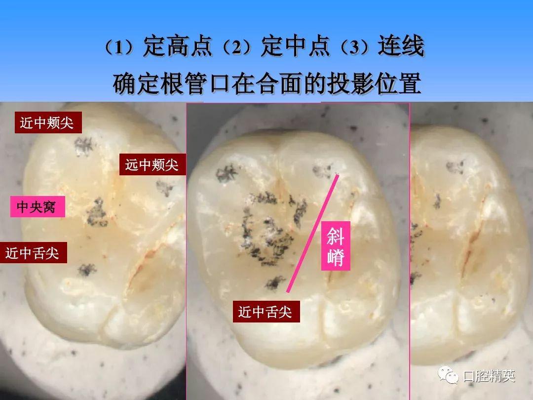 下6开髓图解图片