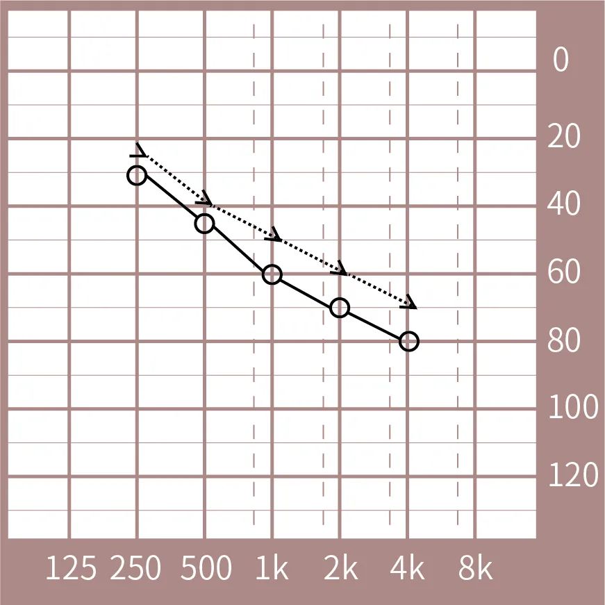 气导和骨导一起下降,高频听力损失较多,听力曲线多下坡性或者陡降型