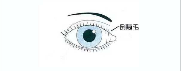 上图为倒睫示意图4,眼部炎症刺激 ,过敏很多老年人有结膜炎或者角膜炎