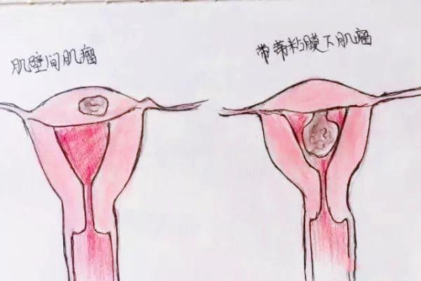 医生手绘畸形子宫图,非常全面,值得收藏!_宫颈