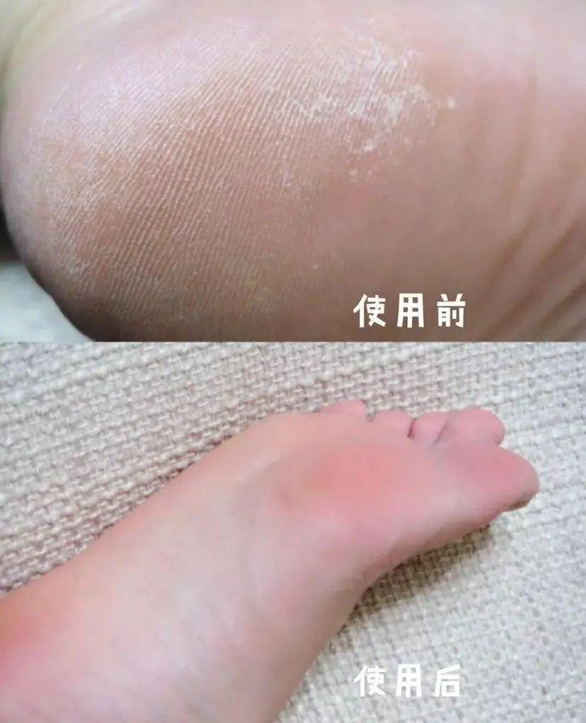 林允居然公开撕脚皮丢掉偶像包袱的她又教了一招护足技巧原来这里才是