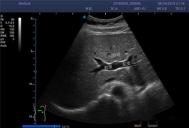 肝脏超声分段图片图片