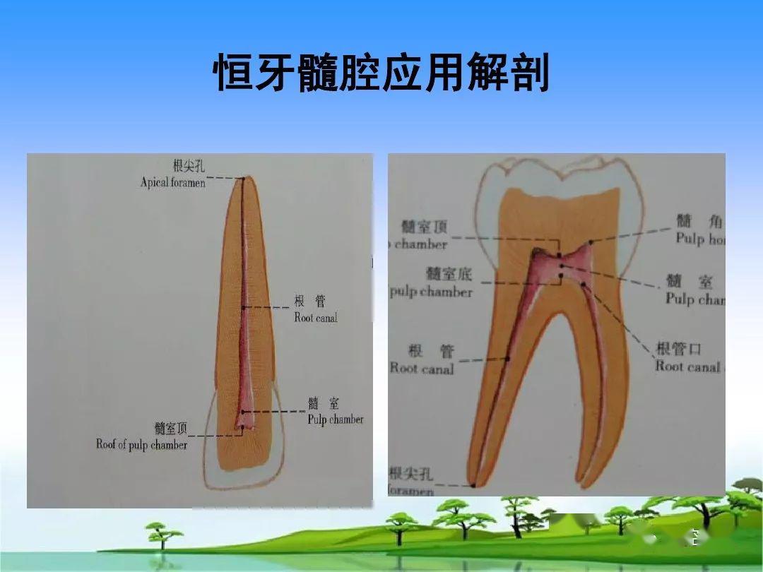 开髓