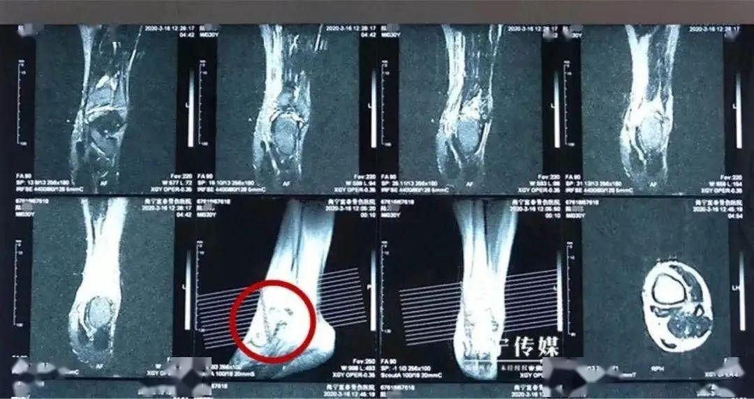 陆先生左踝距腓骨前韧带距骨止点撕裂等多处韧带撕裂,还伴有大量积液