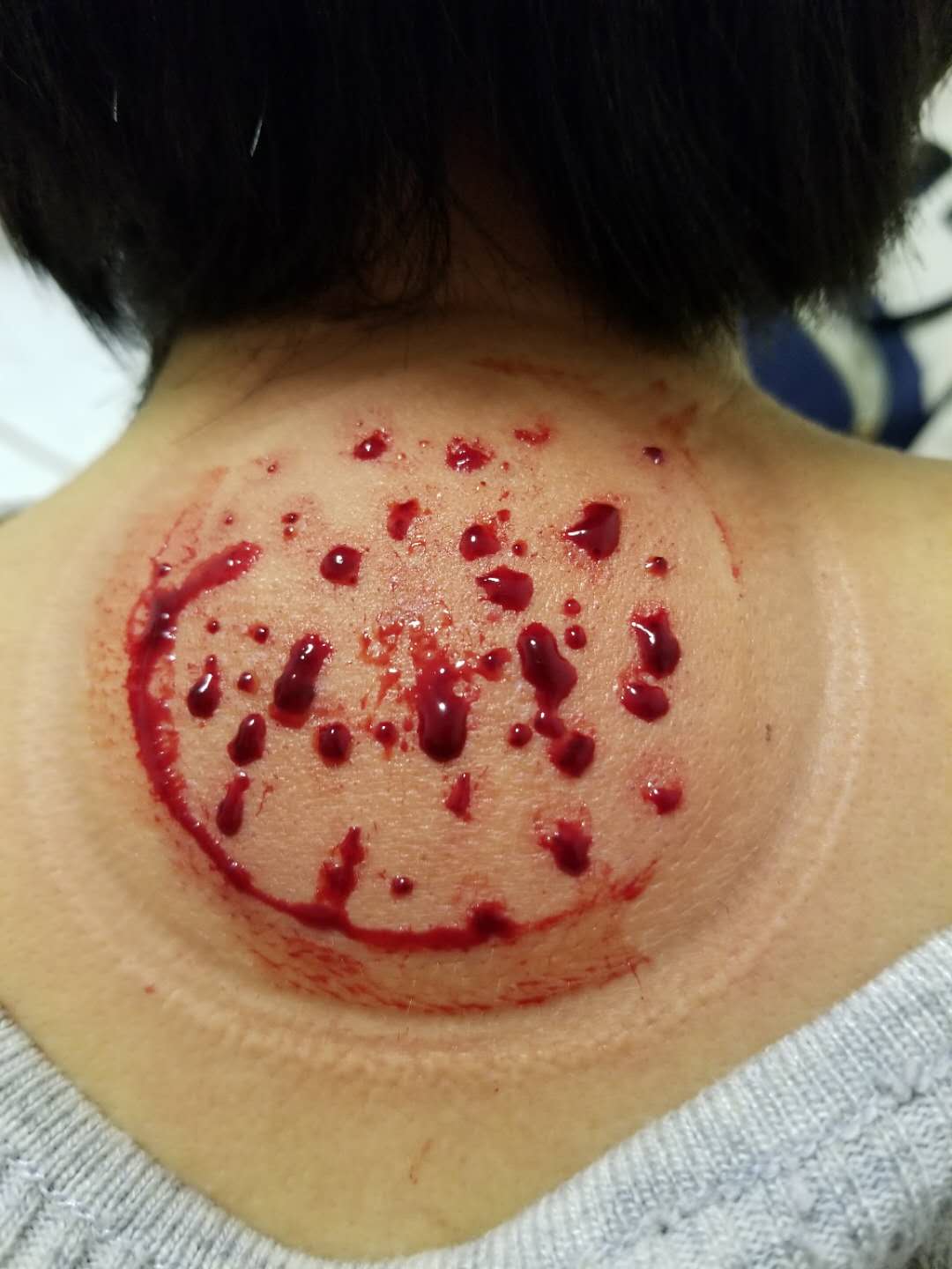 内病外治的方法干预,比如说做艾灸治疗,比如说在大椎穴,点刺放血治疗