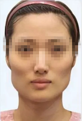 颧骨外突,同时存在明显太阳穴与脸颊凹陷者;严重颧骨外扩或脸宽者;真