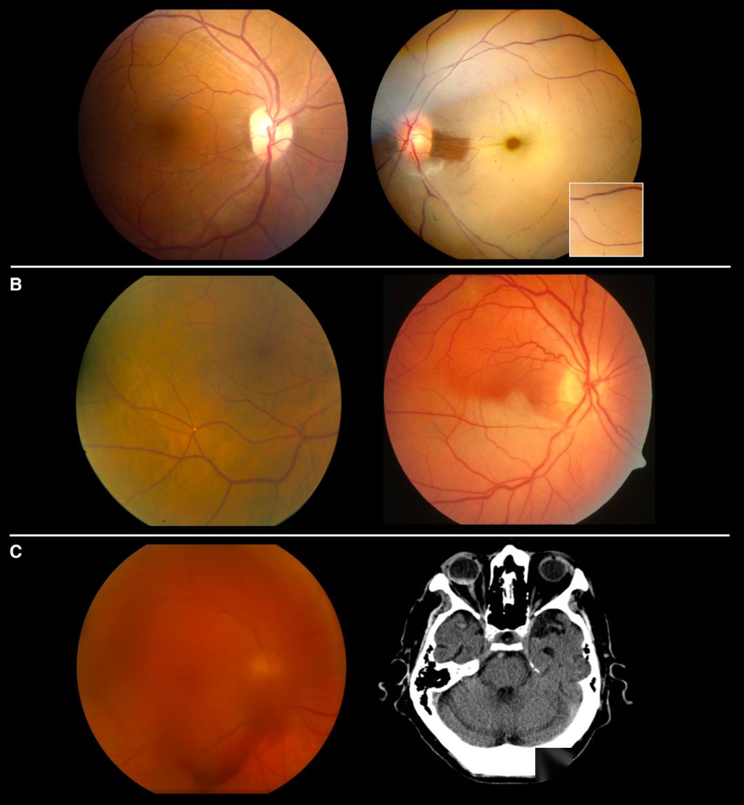 必读文献急性视网膜中央动脉闭塞的溶栓治疗
