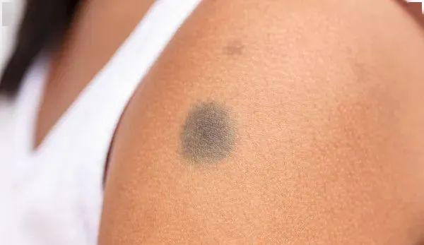 皮肤癌早期常常给出3个警告信号必须重视起来