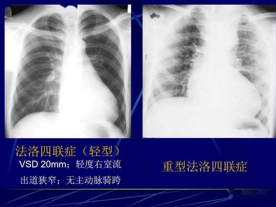 先天性心脏病的影像学诊断