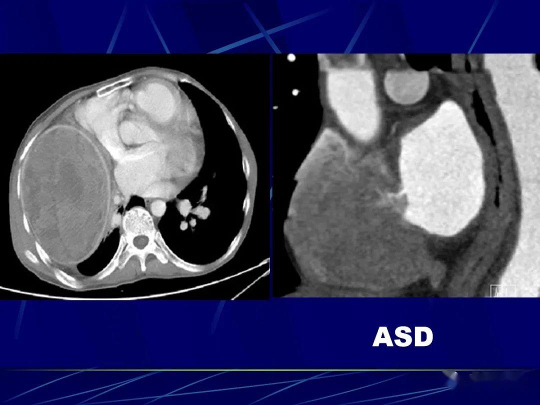 先天性心脏病的影像学诊断