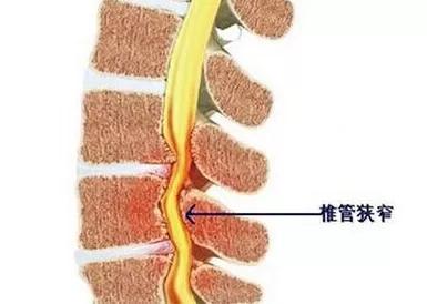 身体有一个治疗"腰椎管狭窄"的开关,打开它,就不痛了_韧带