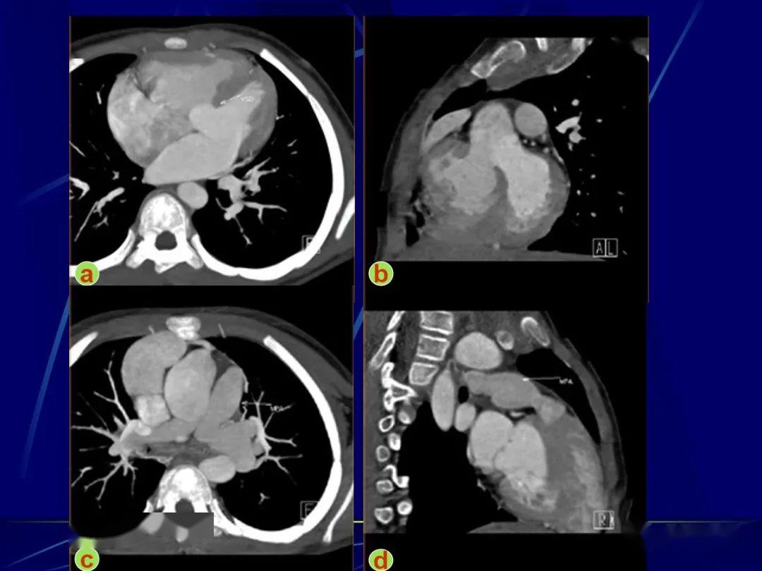 先天性心脏病的影像学诊断
