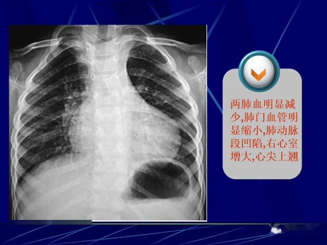 先天性心脏病的影像学诊断