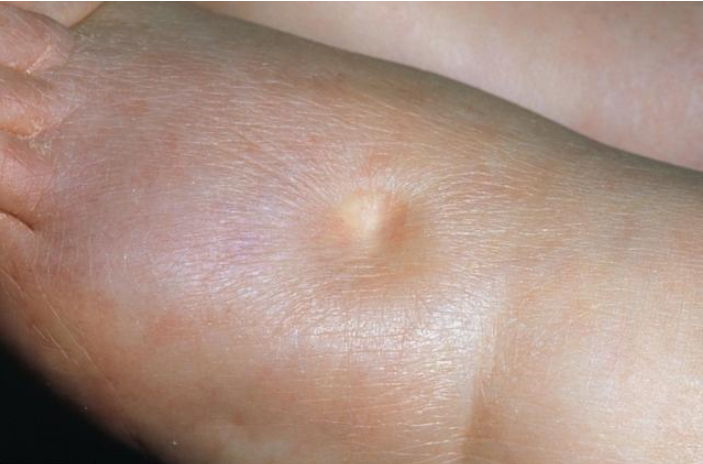 肾性水肿是慢性肾病包括肾炎类,肾综类肾病早期典型的症状.