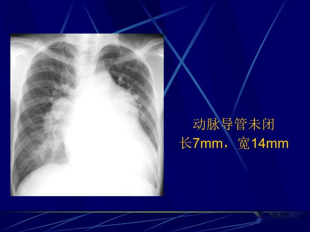 动脉导管未闭x线图片图片