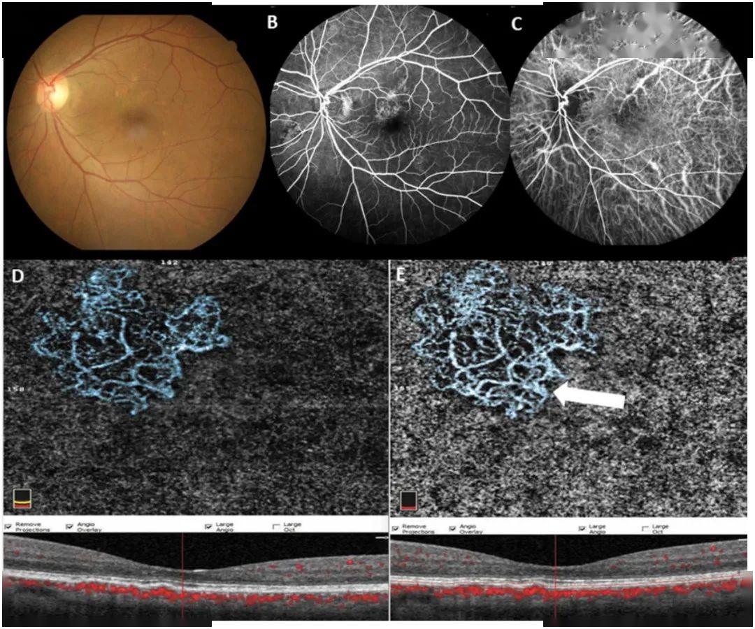 慢性中浆患者脉络膜新生血管的变化