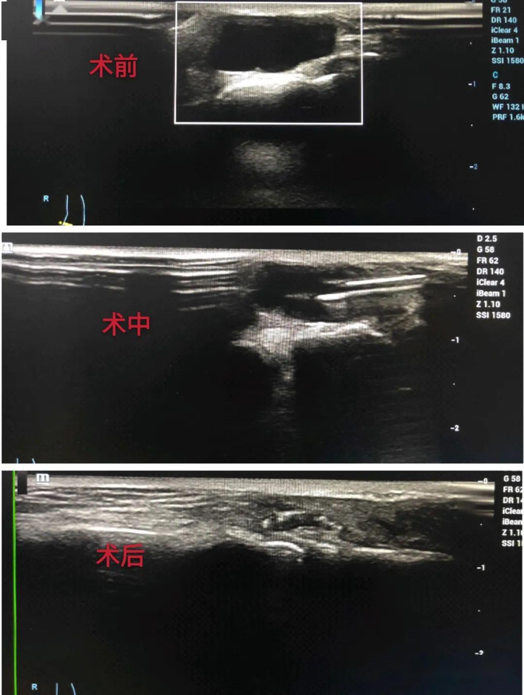 患者李某,女,右足背包块,彩超提示为腱鞘囊肿,如下图箭头所示其优点有