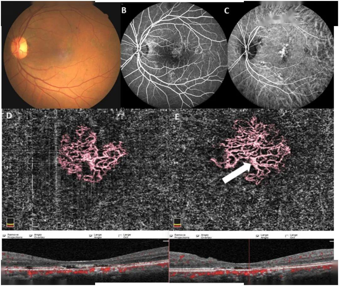 慢性中浆患者脉络膜新生血管的变化