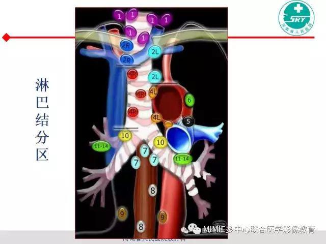 胸部淋巴結分區及其在肺癌定性和分期診斷中的價值