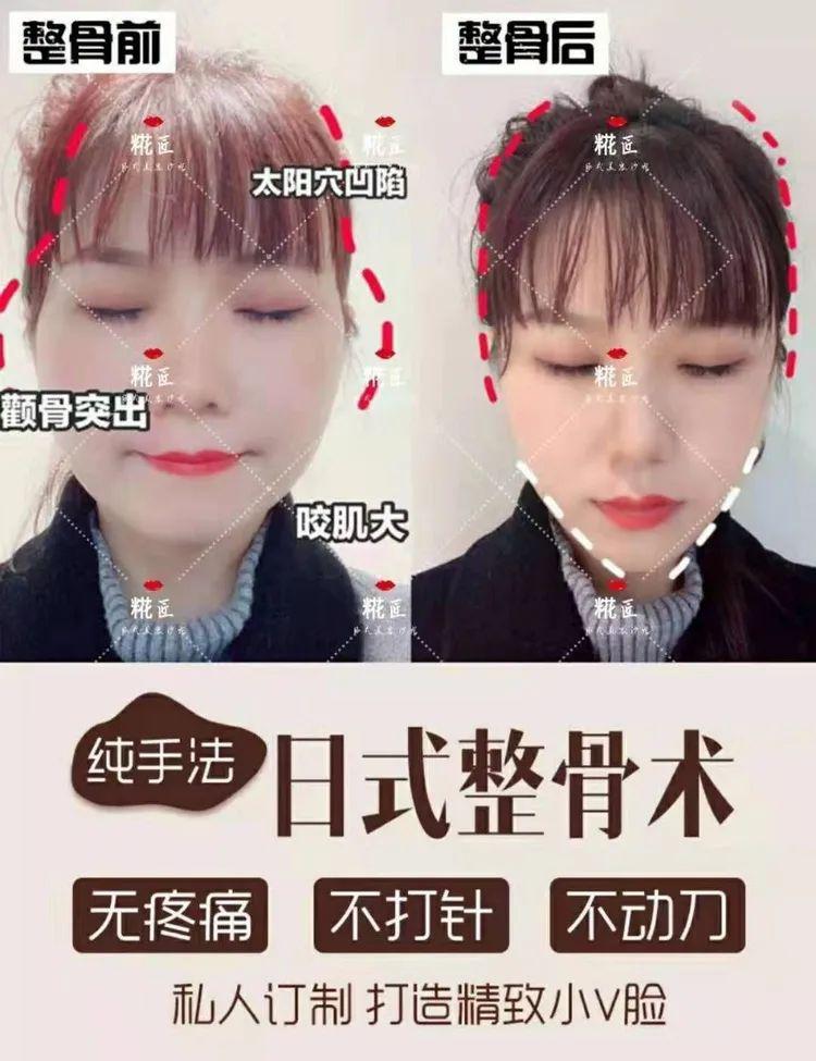 通过日式整骨手法,按照骨骼缝隙走向原理,使骨头缝隙变小,归位.