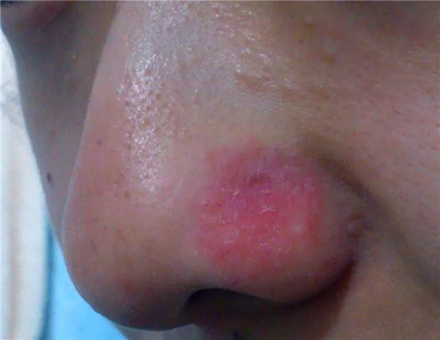 鼻沟脂溢性皮炎症状图图片