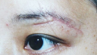 提眉后有一条线的疤提眉要多久恢复真实案例解说