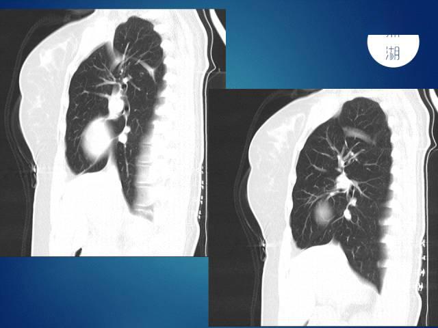 奇叶肺图片图片