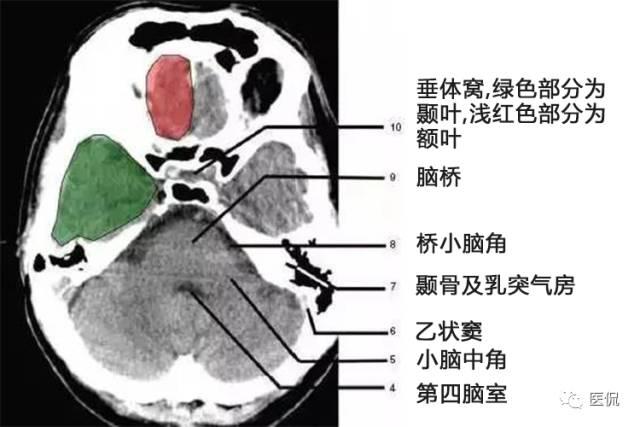 已收藏颅脑ct解剖口诀彩色解剖图