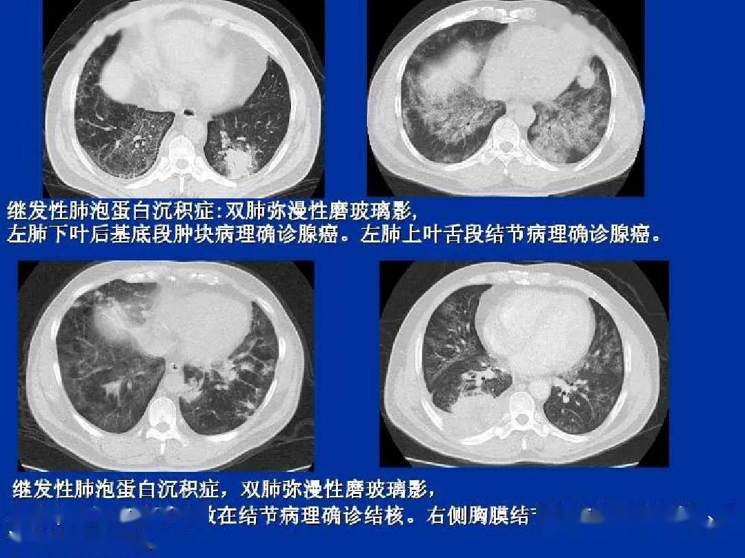 帶你認識肺泡蛋白沉積症的影像表現