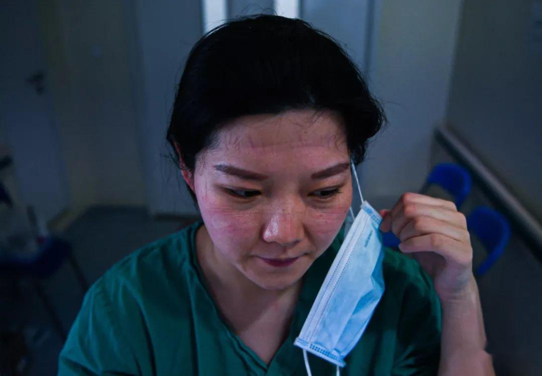 武汉协和医院西院区,摘下口罩的北京援鄂医疗队队员祝丹丹满脸勒痕