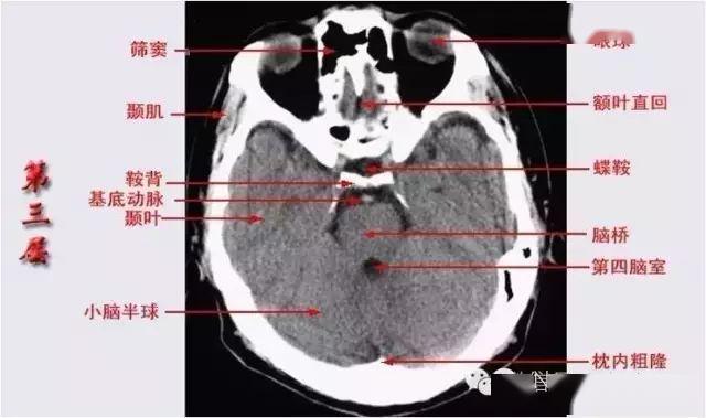已收藏!颅脑ct解剖口诀 彩色解剖图