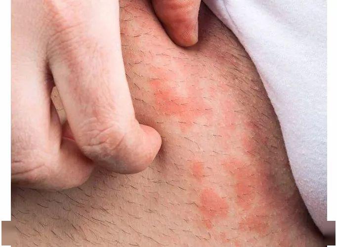 抓出的伤痕只能掩盖瘙痒,真抓出伤来,跟肌肤的真 皮层融合在一起,也不