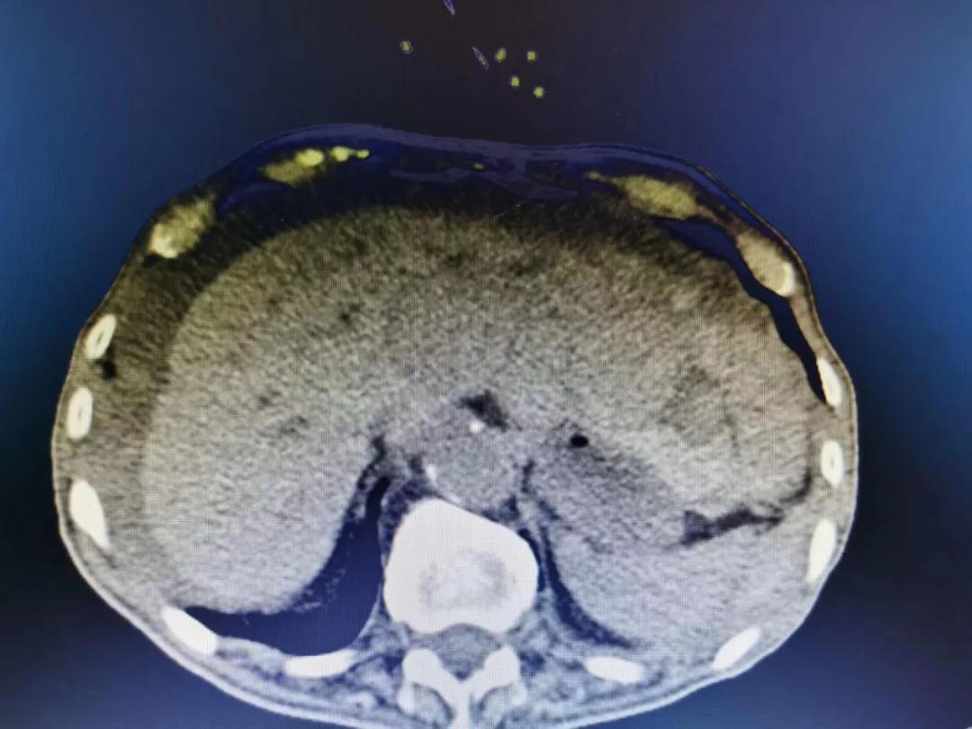 【医生手记】百岁老人左肝肝癌破裂,肝胆外科团队助力生命续航