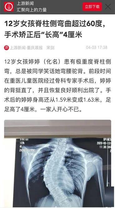 妙手仁心12岁女孩患极重度脊柱侧弯畸形专家手术矫正畸形让女孩长高4