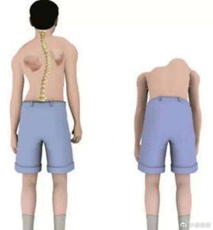 儿童脊柱侧弯有多严重