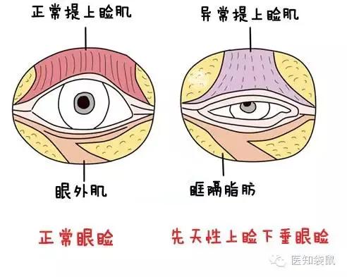 有先天性的,如先天性发育不良,提上睑肌发育不全或者是支配提上睑肌