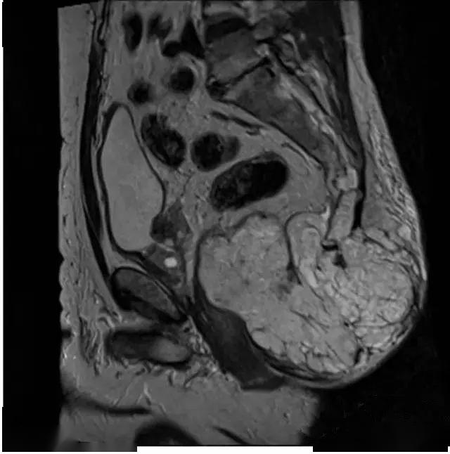 进行性后背部疼痛骶尾椎脊索瘤