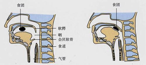 吞咽障碍是怎么回事难道不就是简单的呛咳吗